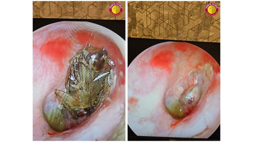 Cockroach in Ear: Dr. Purodha Prasad Saves Delhi Patient in Emergency ENT Case